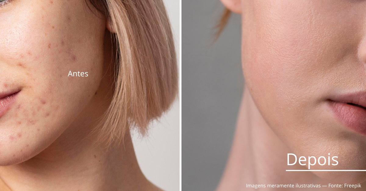 Acne e Espinhas: Estratégias e Tratamentos Comprovados para Cuidar da Sua Pele