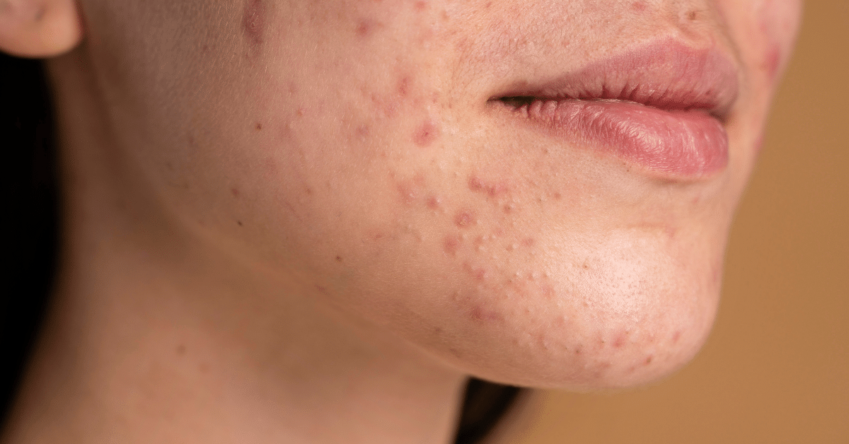 Hidratante causa espinhas? Entenda o que realmente provoca acne