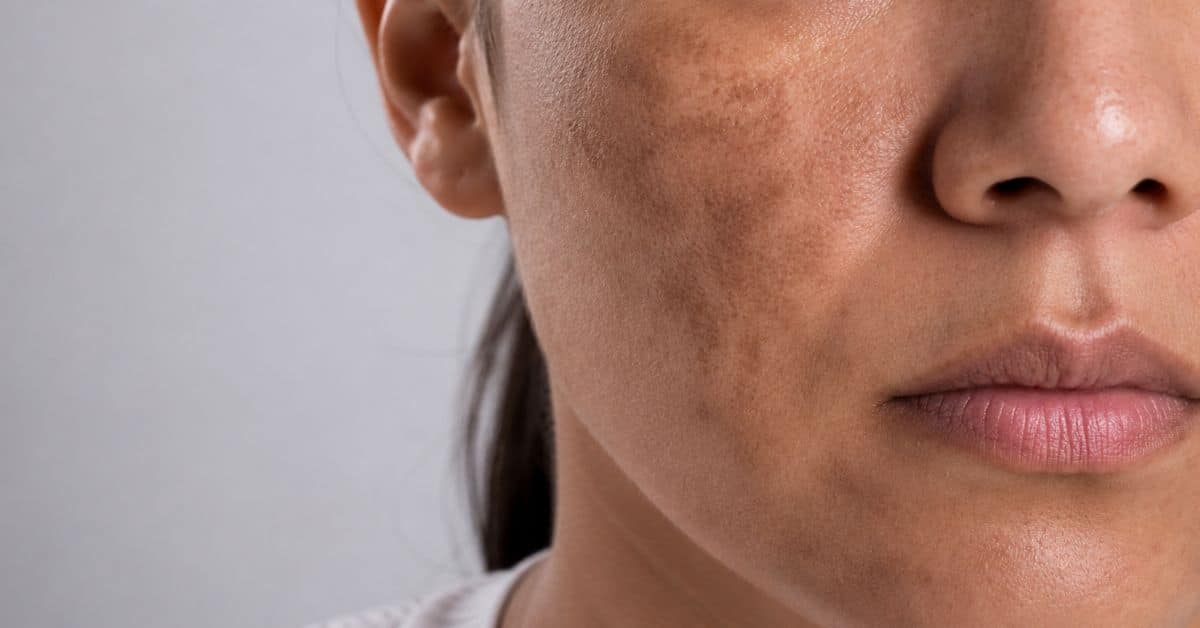 Melasma: os Cremes que viralizam realmente funcionam? O que a ciência diz