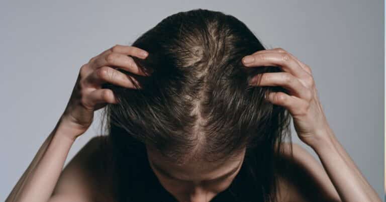 Queda de cabelo: o que causa e o que os médicos dermatologistas recomendam